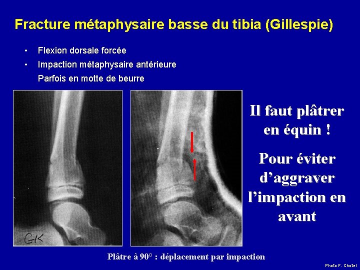 Fracture métaphysaire basse du tibia (Gillespie) • Flexion dorsale forcée • Impaction métaphysaire antérieure