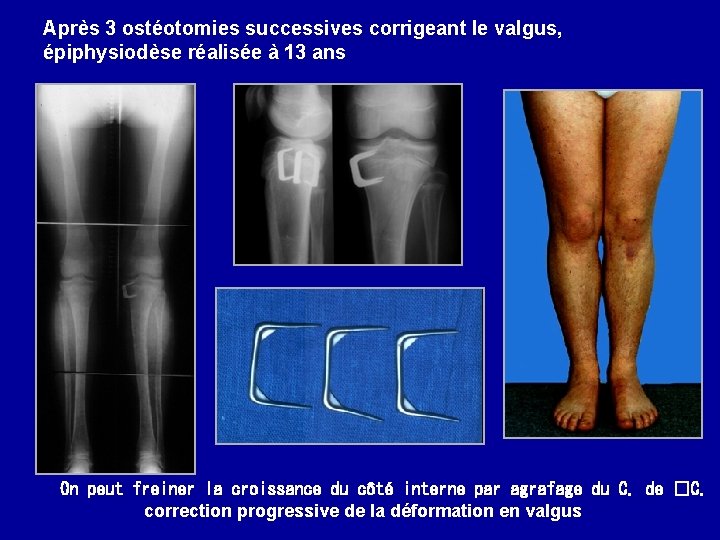 Après 3 ostéotomies successives corrigeant le valgus, épiphysiodèse réalisée à 13 ans On peut