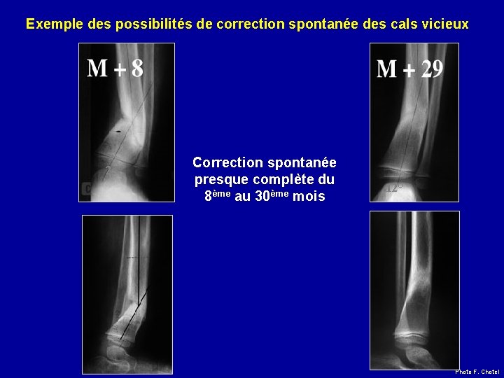 Exemple des possibilités de correction spontanée des cals vicieux 25° Correction spontanée presque complète