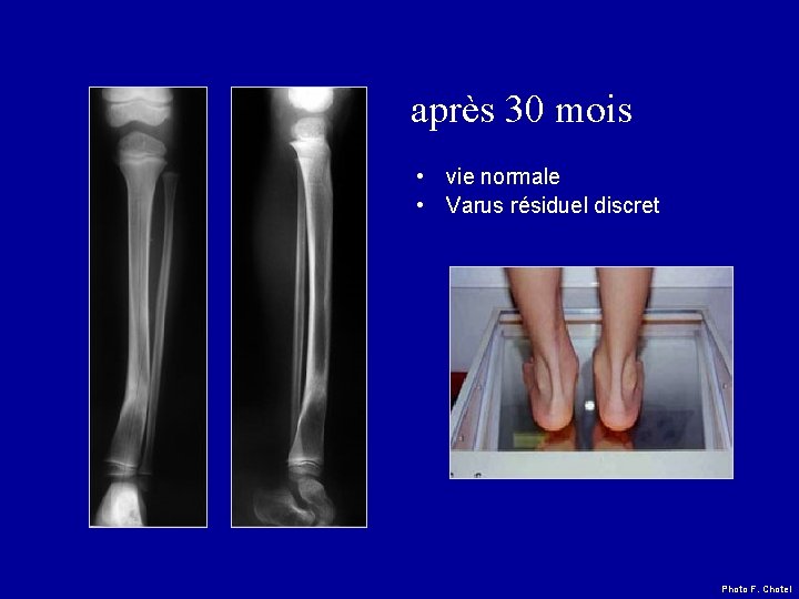 après 30 mois • vie normale • Varus résiduel discret Photo F. Chotel 