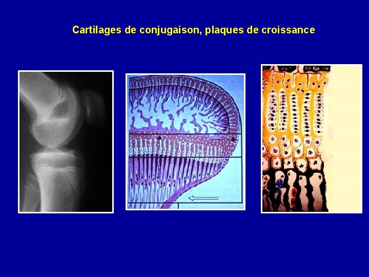 Cartilages de conjugaison, plaques de croissance 