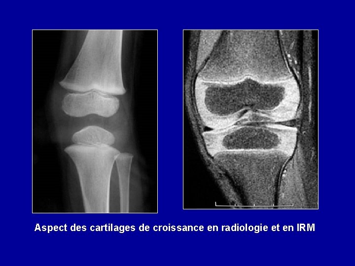 Aspect des cartilages de croissance en radiologie et en IRM 