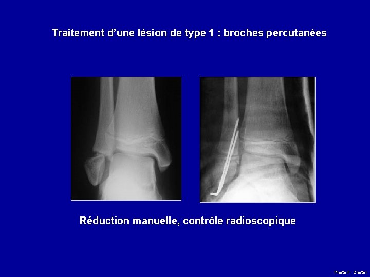 Traitement d’une lésion de type 1 : broches percutanées Réduction manuelle, contrôle radioscopique Photo