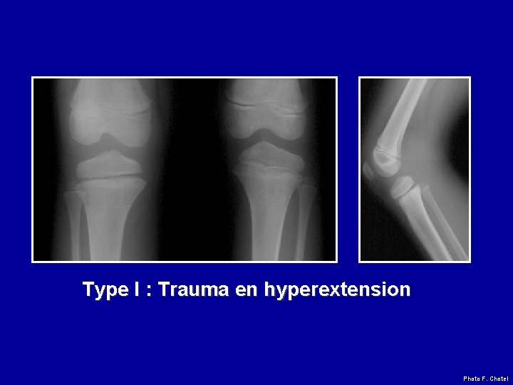 Type I : Trauma en hyperextension Photo F. Chotel 