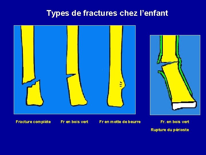 Fractures De Lenfant Coupes Du Fmur Dun Ftus Fractures De Lenfant Coupes Du Fmur Dun Ftus