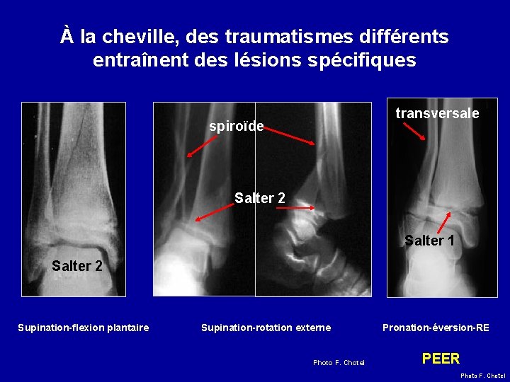 À la cheville, des traumatismes différents entraînent des lésions spécifiques transversale spiroïde Salter 2