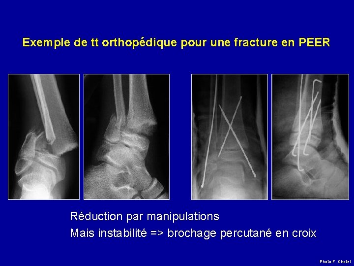  Exemple de tt orthopédique pour une fracture en PEER Réduction par manipulations Mais