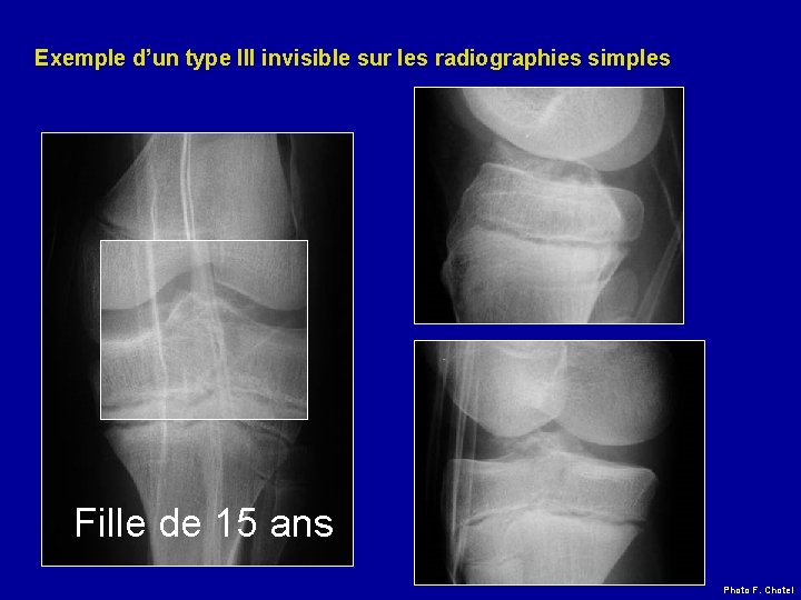 Exemple d’un type III invisible sur les radiographies simples Fille de 15 ans Photo