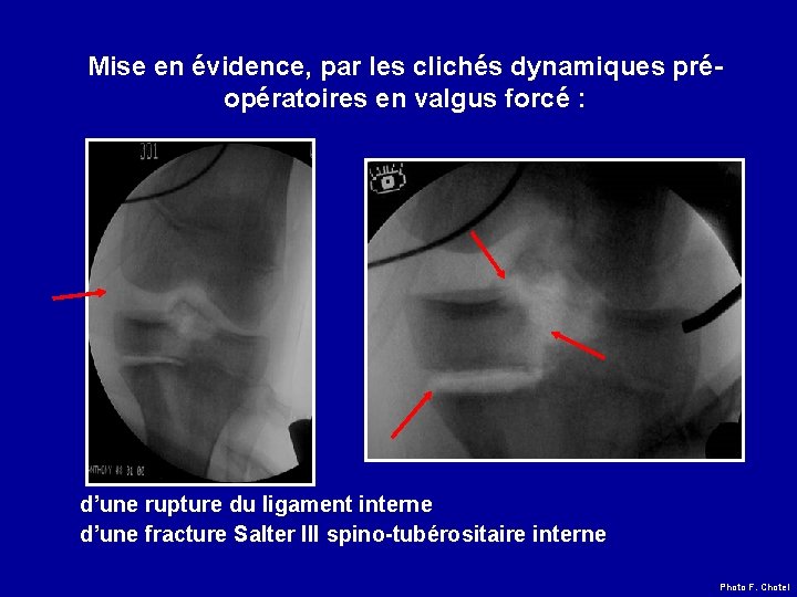 Mise en évidence, par les clichés dynamiques préopératoires en valgus forcé : d’une rupture
