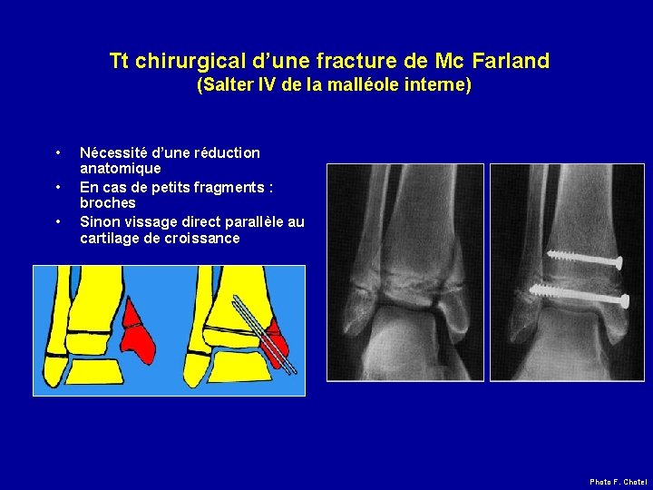 Tt chirurgical d’une fracture de Mc Farland (Salter IV de la malléole interne) •