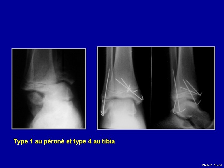 Type 1 au péroné et type 4 au tibia Photo F. Chotel 