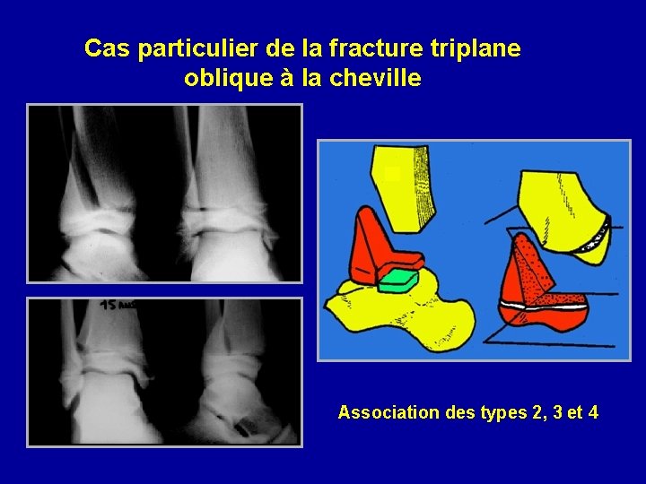 Cas particulier de la fracture triplane oblique à la cheville Association des types 2,