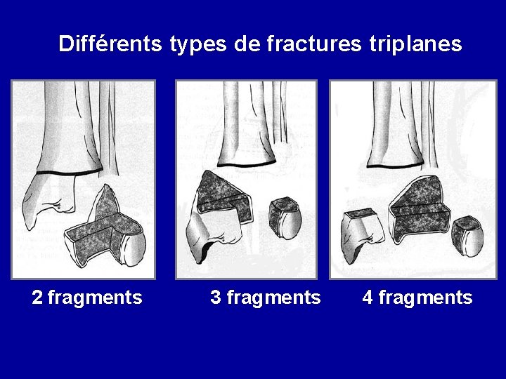 Différents types de fractures triplanes 2 fragments 3 fragments 4 fragments 