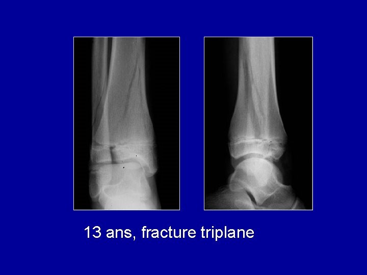 13 ans, fracture triplane 