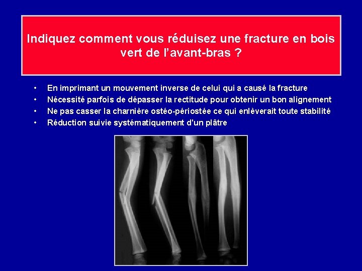 Indiquez comment vous réduisez une fracture en bois vert de l’avant-bras ? • •