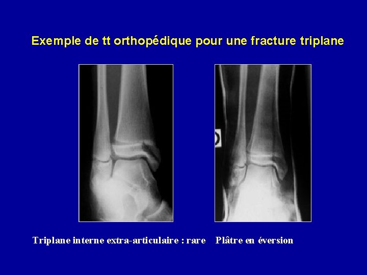  Exemple de tt orthopédique pour une fracture triplane Triplane interne extra-articulaire : rare