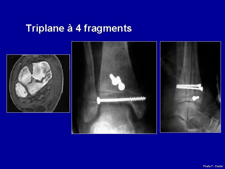 Triplane à 4 fragments Photo F. Chotel 