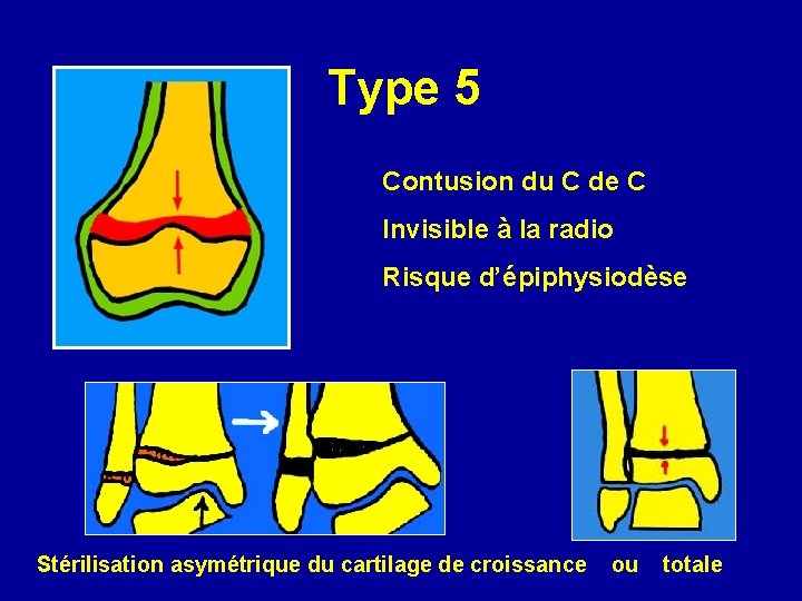 Type 5 Contusion du C de C Invisible à la radio Risque d’épiphysiodèse Stérilisation