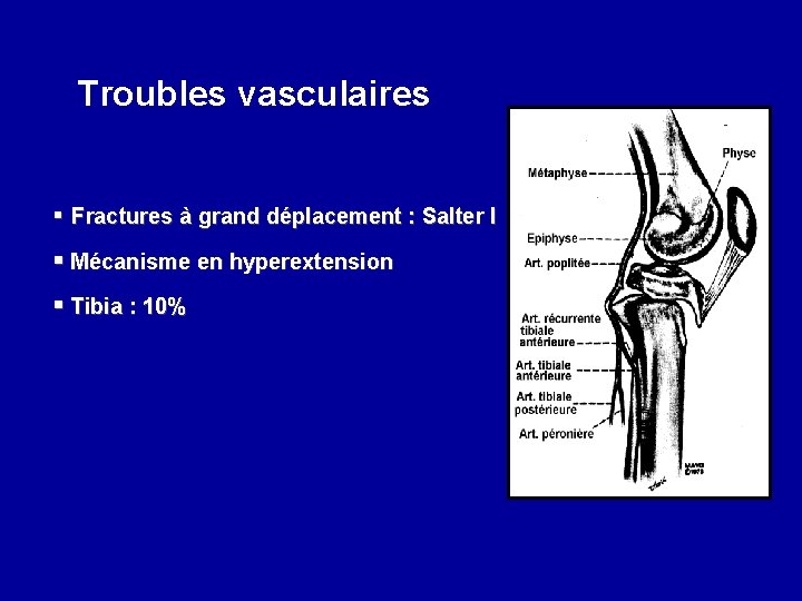 Troubles vasculaires § Fractures à grand déplacement : Salter I § Mécanisme en hyperextension
