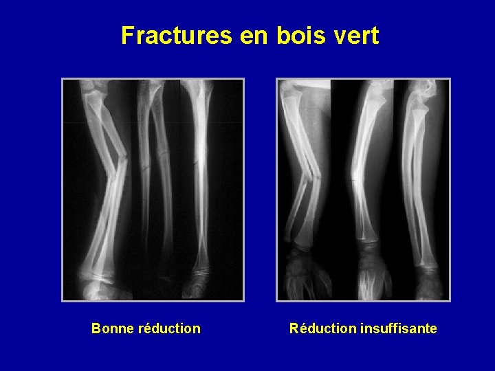 Fractures en bois vert Bonne réduction Réduction insuffisante 