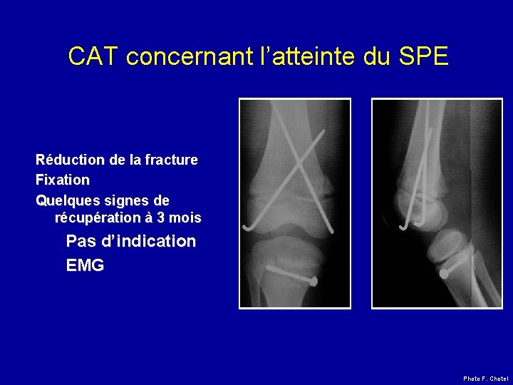 CAT concernant l’atteinte du SPE Réduction de la fracture Fixation Quelques signes de récupération