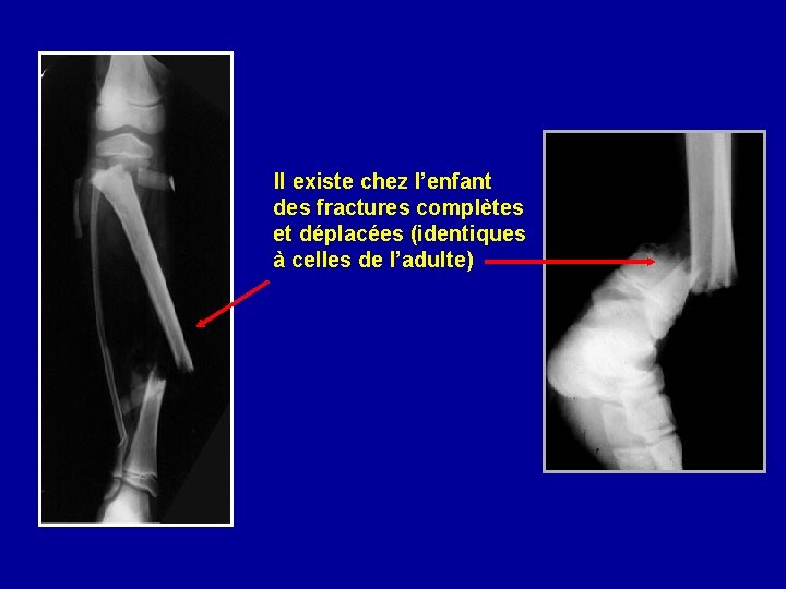  Il existe chez l’enfant des fractures complètes et déplacées (identiques à celles de