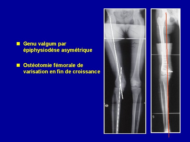 n Genu valgum par épiphysiodèse asymétrique n Ostéotomie fémorale de varisation en fin de
