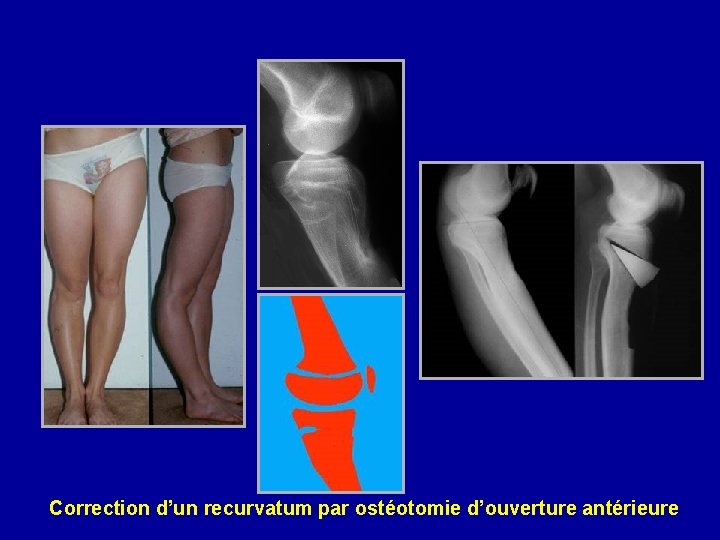 Correction d’un recurvatum par ostéotomie d’ouverture antérieure 