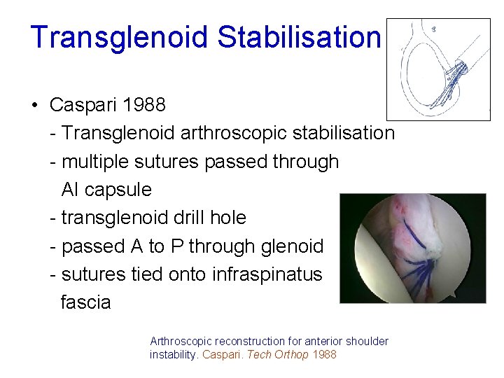 Transglenoid Stabilisation • Caspari 1988 - Transglenoid arthroscopic stabilisation - multiple sutures passed through