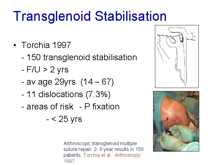 Transglenoid Stabilisation • Torchia 1997 - 150 transglenoid stabilisation - F/U > 2 yrs