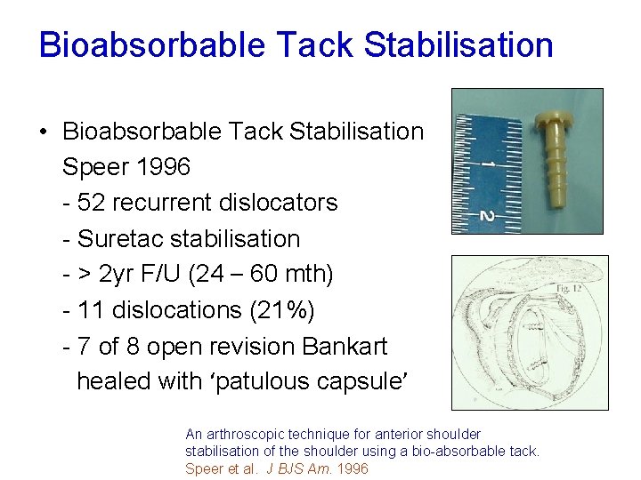 Bioabsorbable Tack Stabilisation • Bioabsorbable Tack Stabilisation Speer 1996 - 52 recurrent dislocators -