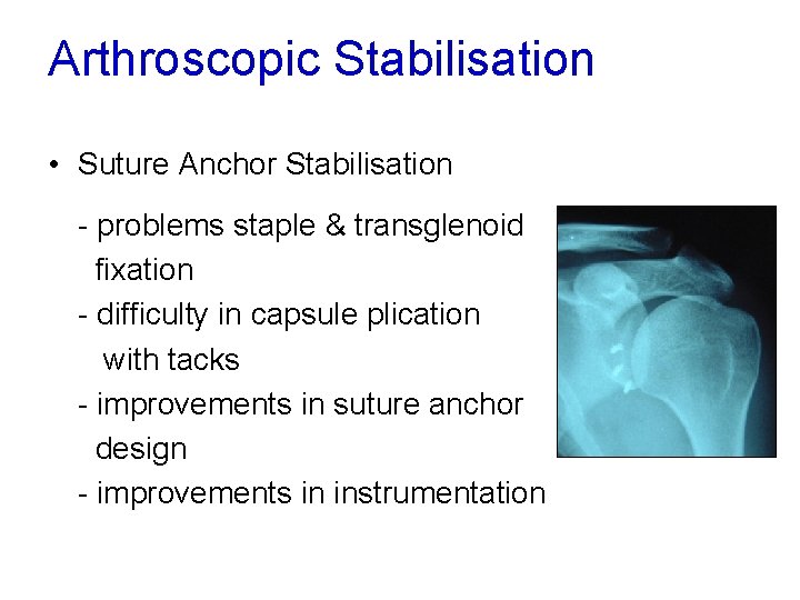 Arthroscopic Stabilisation • Suture Anchor Stabilisation - problems staple & transglenoid fixation - difficulty