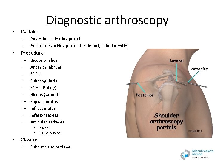 Diagnostic arthroscopy • Portals – Posterior – viewing portal – Anterior- working portal (inside