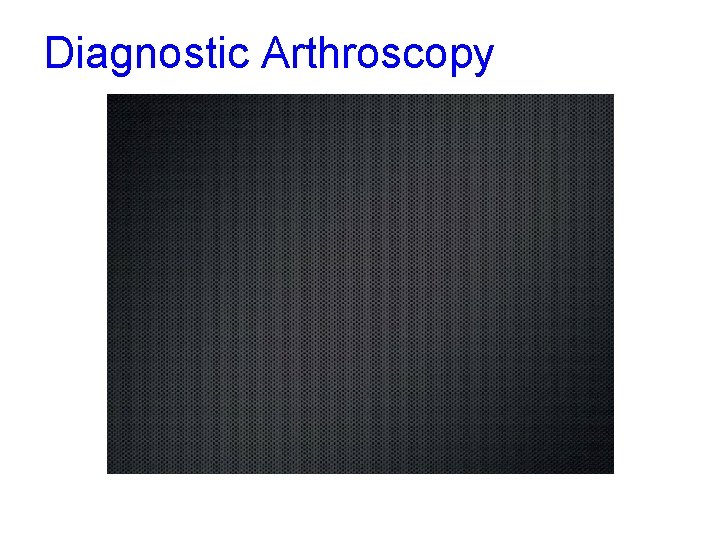 Diagnostic Arthroscopy 