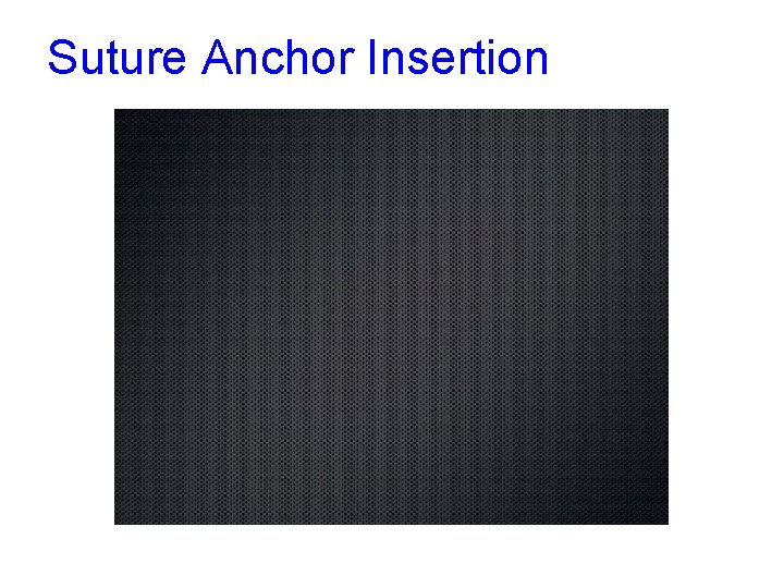 Suture Anchor Insertion 