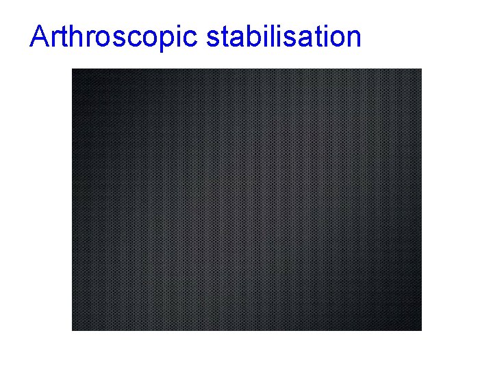 Arthroscopic stabilisation 