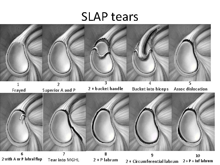 SLAP tears 1 Frayed 6 2 with A or P labral flap 2 Superior