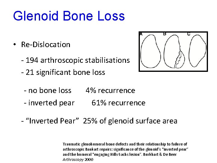 Glenoid Bone Loss • Re-Dislocation - 194 arthroscopic stabilisations - 21 significant bone loss