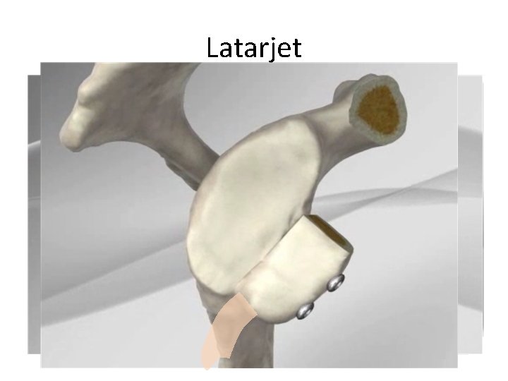 Latarjet 