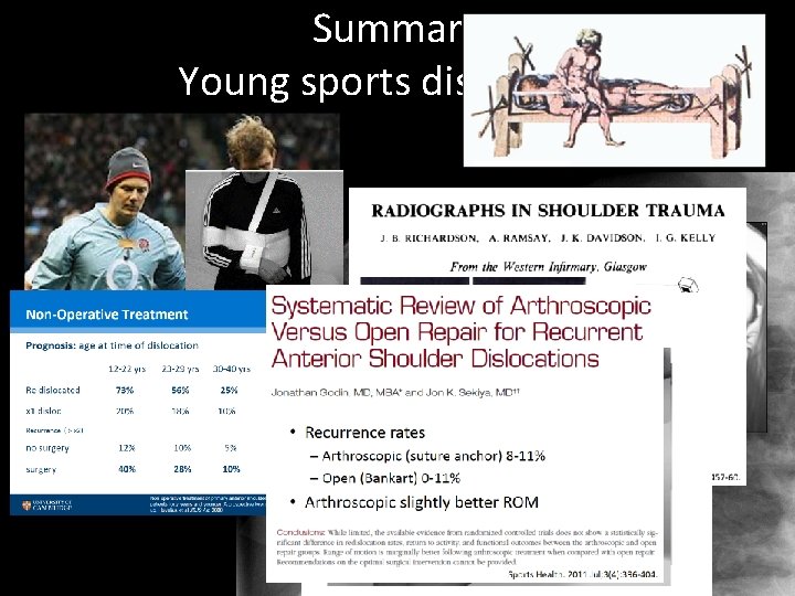 Summary Young sports dislocation 1 week 