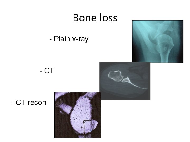 Bone loss - Plain x-ray - CT recon 