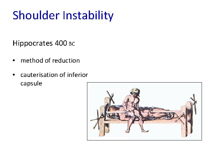 Shoulder Instability Hippocrates 400 BC • method of reduction • cauterisation of inferior capsule