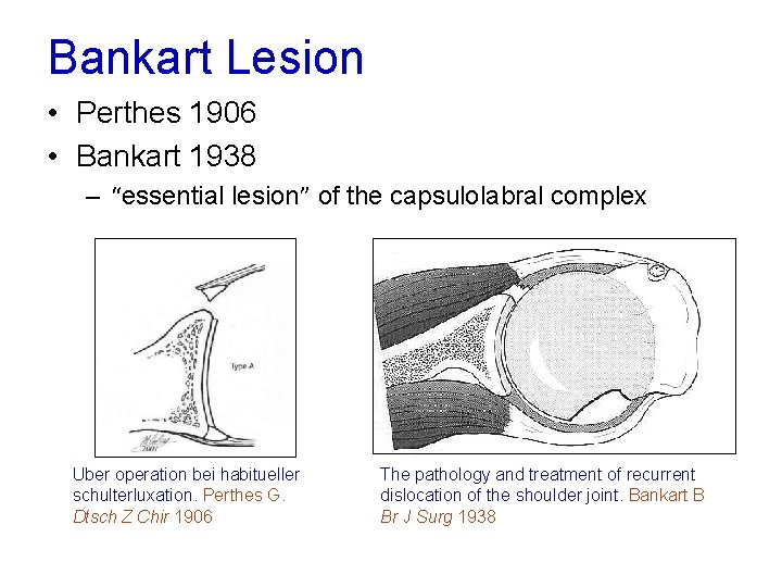 Bankart Lesion • Perthes 1906 • Bankart 1938 – “essential lesion” of the capsulolabral