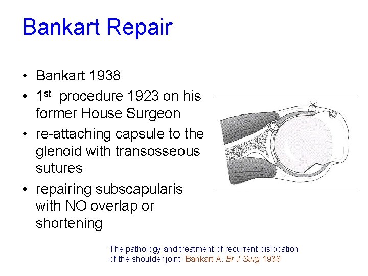 Bankart Repair • Bankart 1938 • 1 st procedure 1923 on his former House