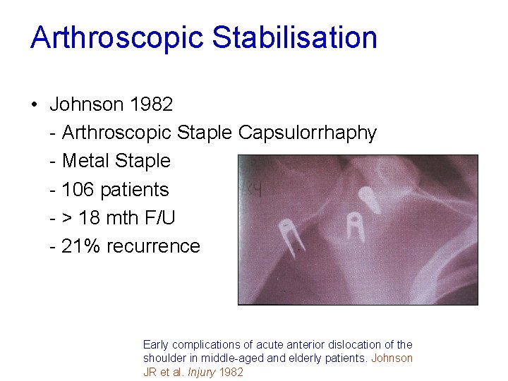 Arthroscopic Stabilisation • Johnson 1982 - Arthroscopic Staple Capsulorrhaphy - Metal Staple - 106