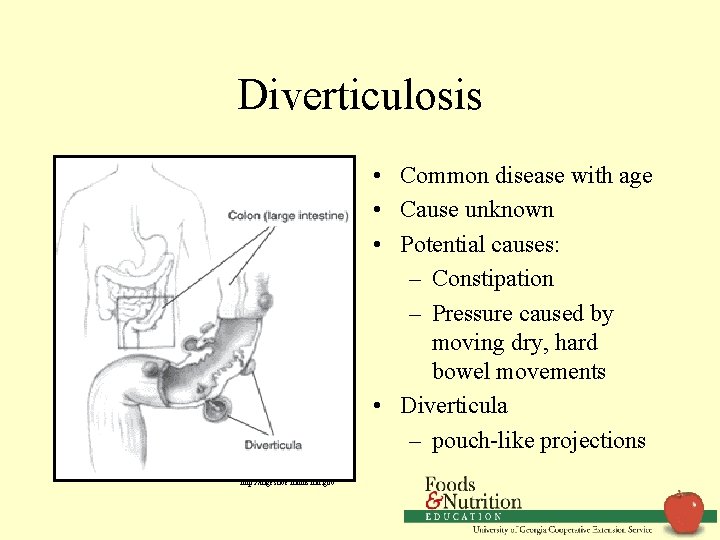 Diverticulosis • Common disease with age • Cause unknown • Potential causes: – Constipation
