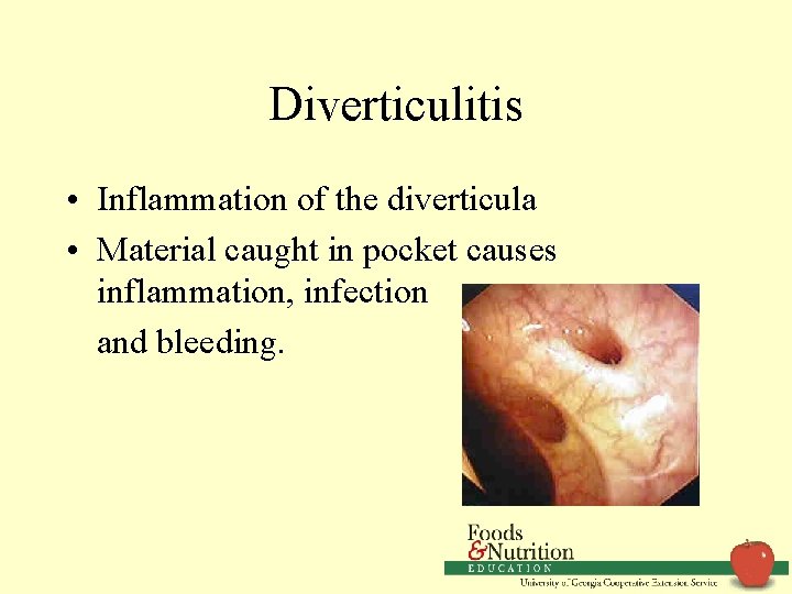 Diverticulitis • Inflammation of the diverticula • Material caught in pocket causes inflammation, infection
