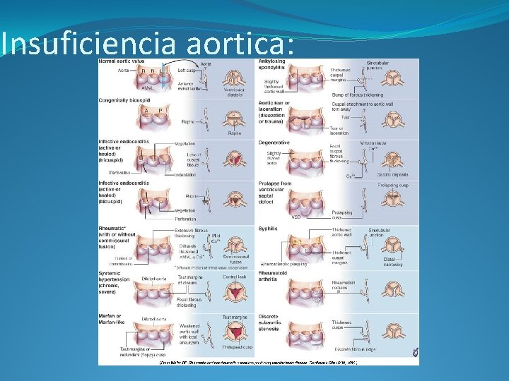 Insuficiencia aortica: 