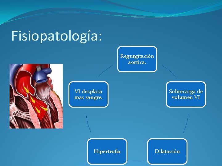 Fisiopatología: Regurgitación aortica. VI desplaza mas sangre. Hipertrofia Sobrecarga de volumen VI Dilatación 