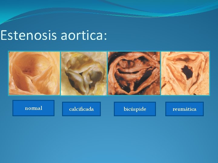 Estenosis aortica: normal calcificada bicúspide reumática 
